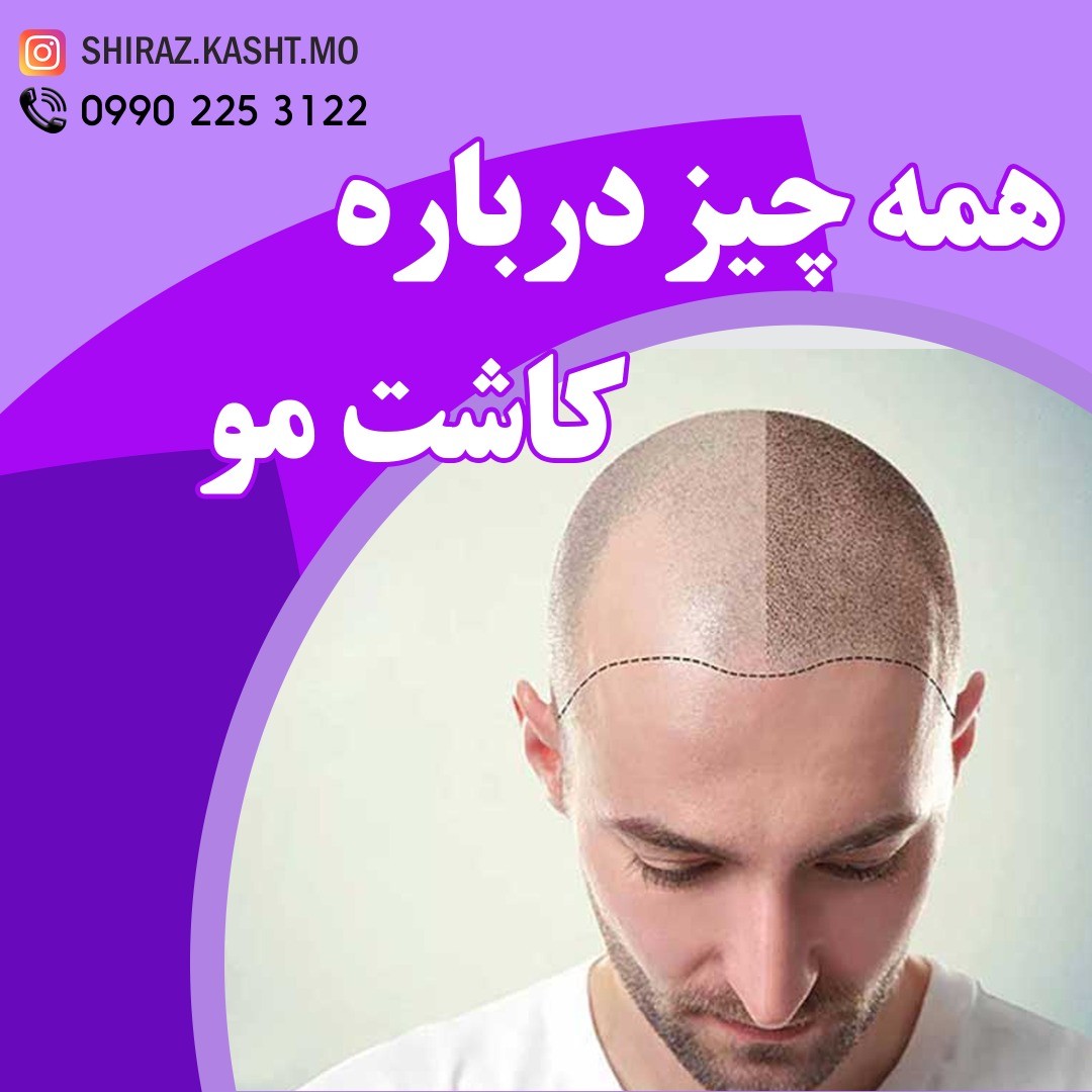 کاشت مو وابرو تخصصی شیراز