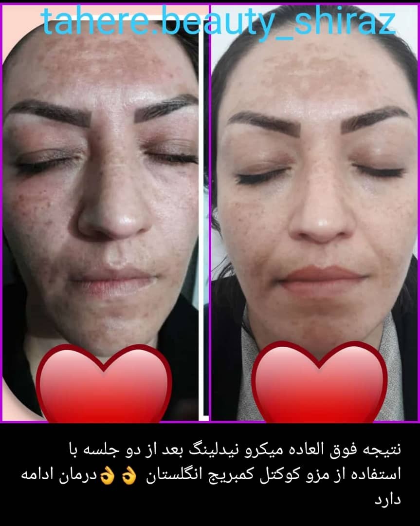 خدمات و آموزش میکرونیدلینگ  و هایفو تراپی و مزو تراپی و میکرو درم (پاکسازی صورت)
همراه با مدرک 

